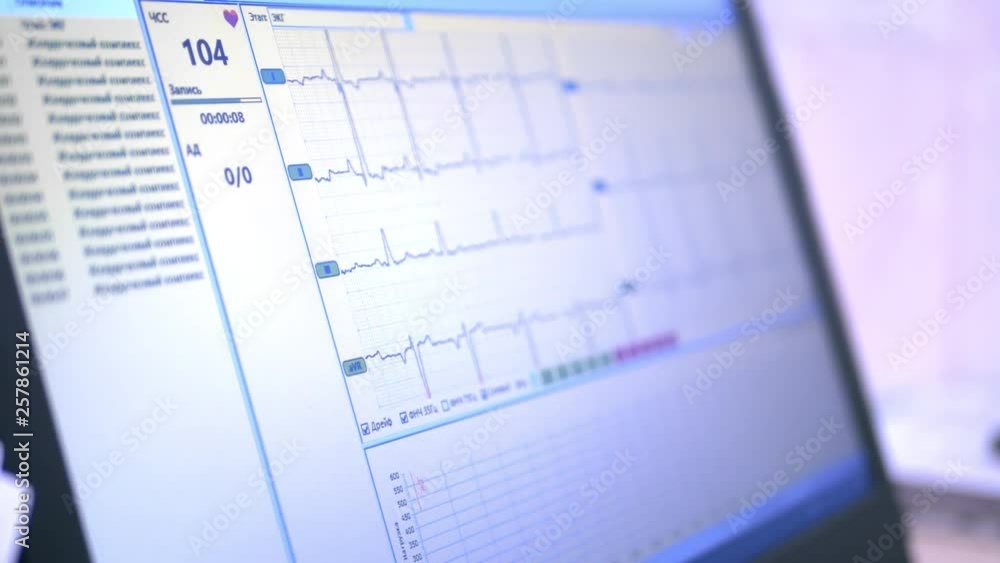 Close-up cardiogram graphic on laptop screen. The number of strokes above the normal value Close-up cardiogram graphic on laptop screen. The number of strokes above the normal value