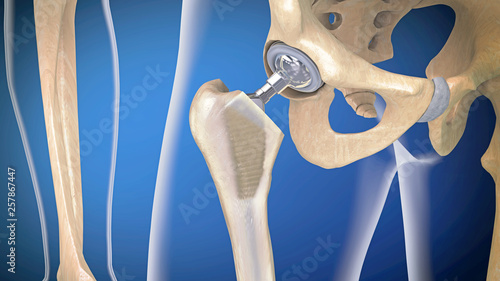 Schilderij op canvas Function of a hip joint implant or hip prosthesis in frontal view - 3d illustrat