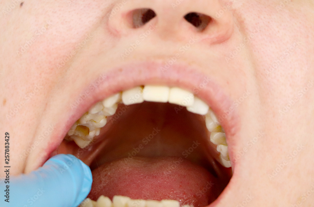 Obraz premium The hole in the tooth and the treatment of dental canals. Treatment of periodontitis in the dental clinic