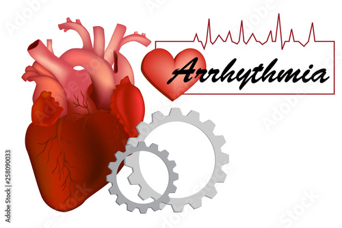 Heart arrhythmia (also known as arrhythmia, dysrhythmia, or irregular heartbeat). photo