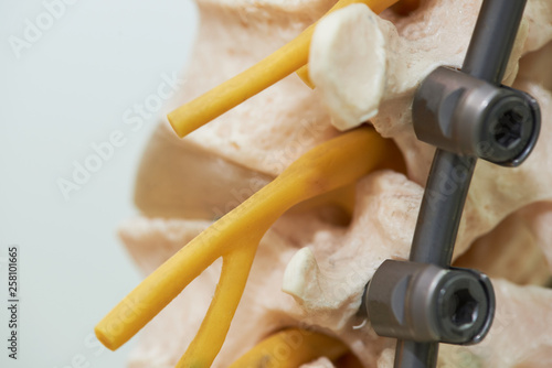 Bild auf Leinwand Close-up view of human lumbar spine model and instrumentation fixation with rod