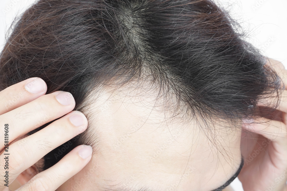 Young man serious hair loss problem for health care medical and shampoo product concept Young man serious hair loss problem for health care medical and shampoo product concept