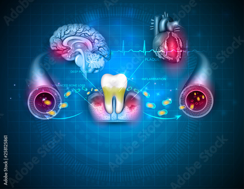 Inflamed gums bacteria