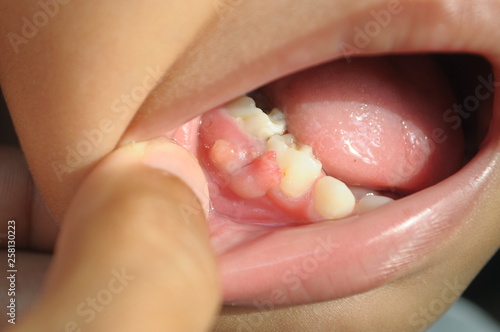 A gum boil is medically called as Parulus or abscess. It is an itchy fluid that fills like a bump and appears to be painful on the gums.