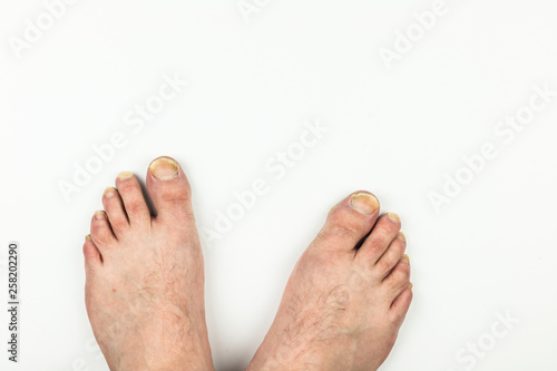 Uncut dirty toe nails, both feet photo