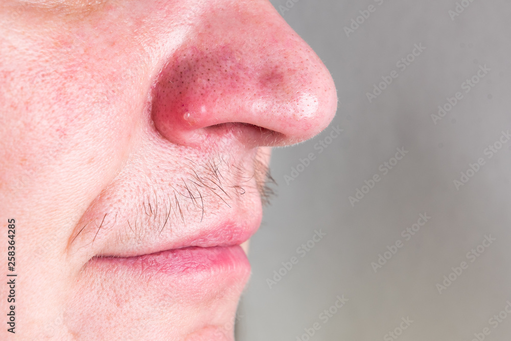 Black dots and acne on the nose. Black dots and acne on the nose.