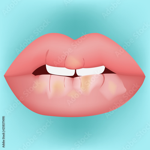 Dry mouth vector illustration