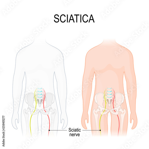 sciatica. Human body with Sciatic nerve.