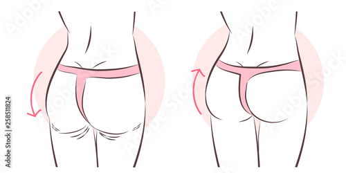 butt implant before and after