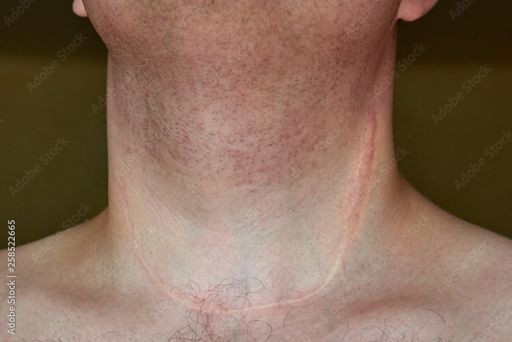 Scar on the neck of a man after removal of the thyroid gland Scar on the neck of a man after removal of the thyroid gland