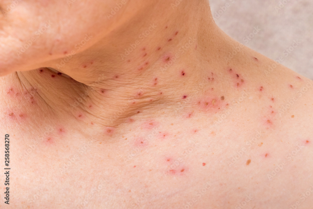 Traces of removal of papillomas on the neck of a woman_ Traces of removal of papillomas on the neck of a woman_