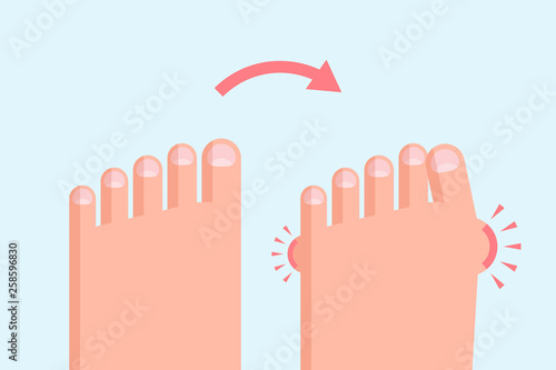 Healthy and deformed feet