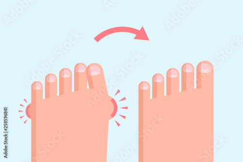 Deformed and healthy feet