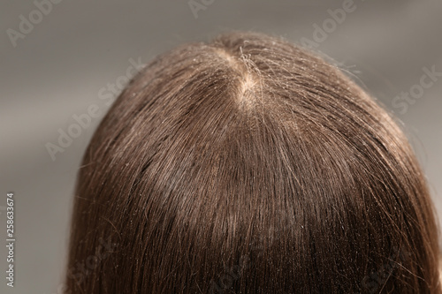 Woman with dandruff in her dark hair on grey background, closeup