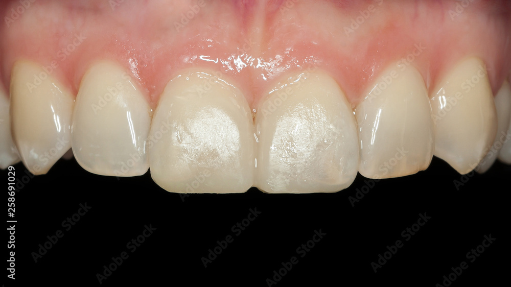 Obraz premium Veneer aus Keramik auf den oberen großen Schneidezähnen Behandlungsablauf