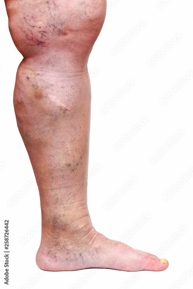Naklejka premium The varicose veins
