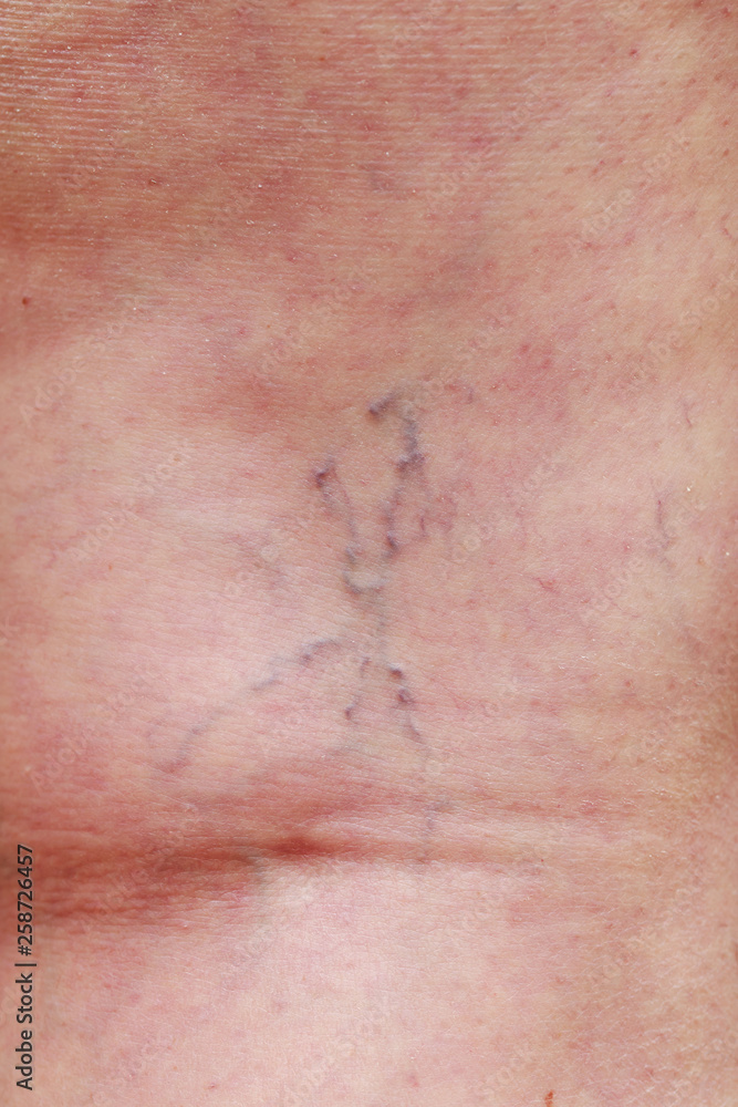 The varicose veins The varicose veins