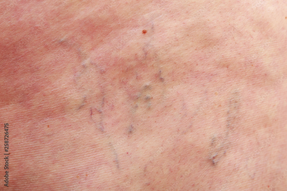 The varicose veins The varicose veins