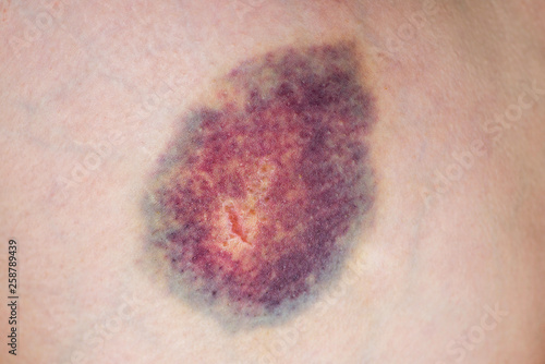 Closeup on a Bruise on wounded woman leg skin. Close up on a bruise on wounded woman leg skin. Gender violence concept photo