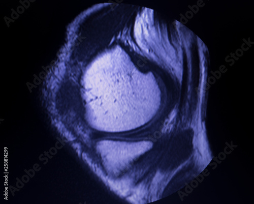 Photography MRI knee meniscus tear scan