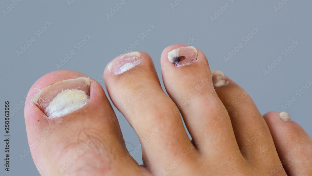 Single Right Male Foot with a Fungal Infection in the Toe Nails which are  cracked and