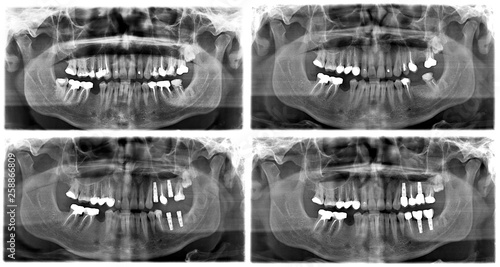 X ray of teeth