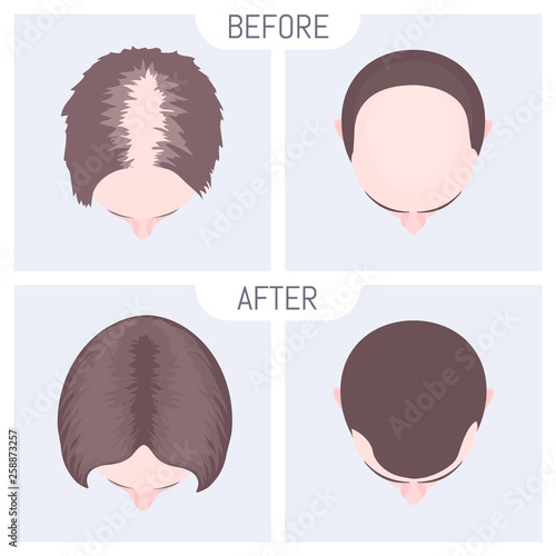 Male and female pattern hair loss set. Baldness treatment result in men and women. Before and after concept. Alopecia infographic medical vector template for clinics and diagnostics centres.