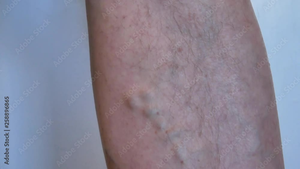 doctor inspecting leg of old man with varicose veins - enlarged, swollen, and twisting veins when blood flow in the wrong direction. close-up 4k video footage doctor inspecting leg of old man with varicose veins - enlarged, swollen, and twisting veins when blood flow in the wrong direction. close-up 4k video footage
