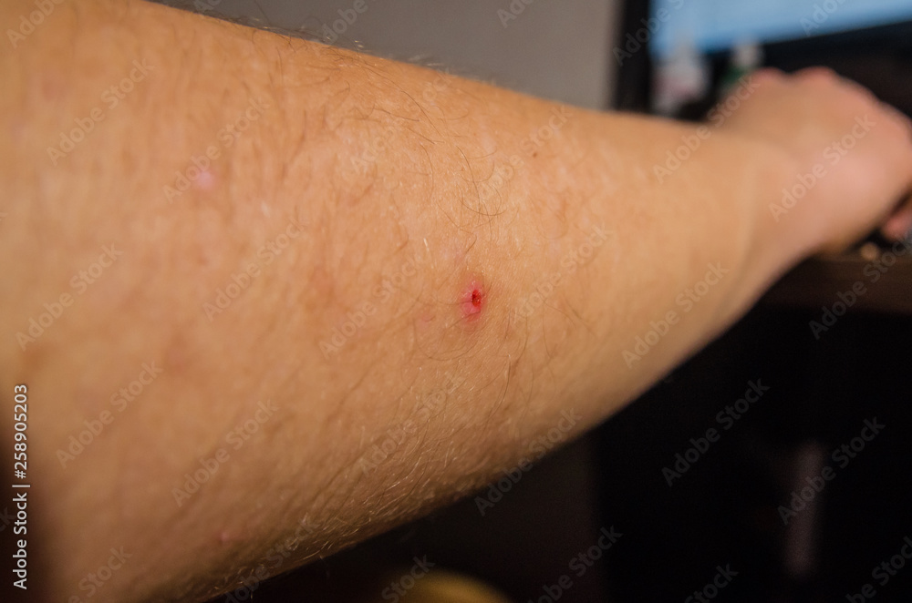 Fototapeta premium a pimple on the arm