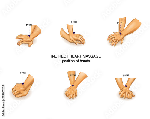 position of the doctor's hands in indirect heart massage photo