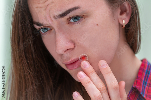 Young woman suffering from herpes on lips. Treatment of herpes infection and virus