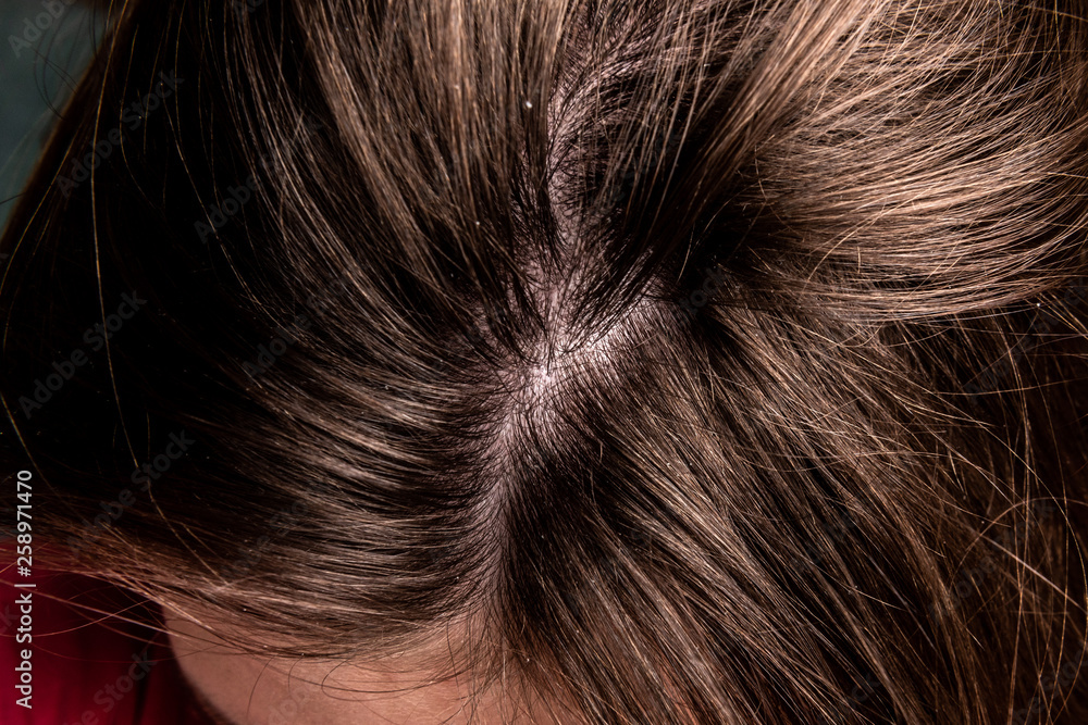 Unhealthy head skin. Problem hair loss, dandruff. Unhealthy head skin. Problem hair loss, dandruff.