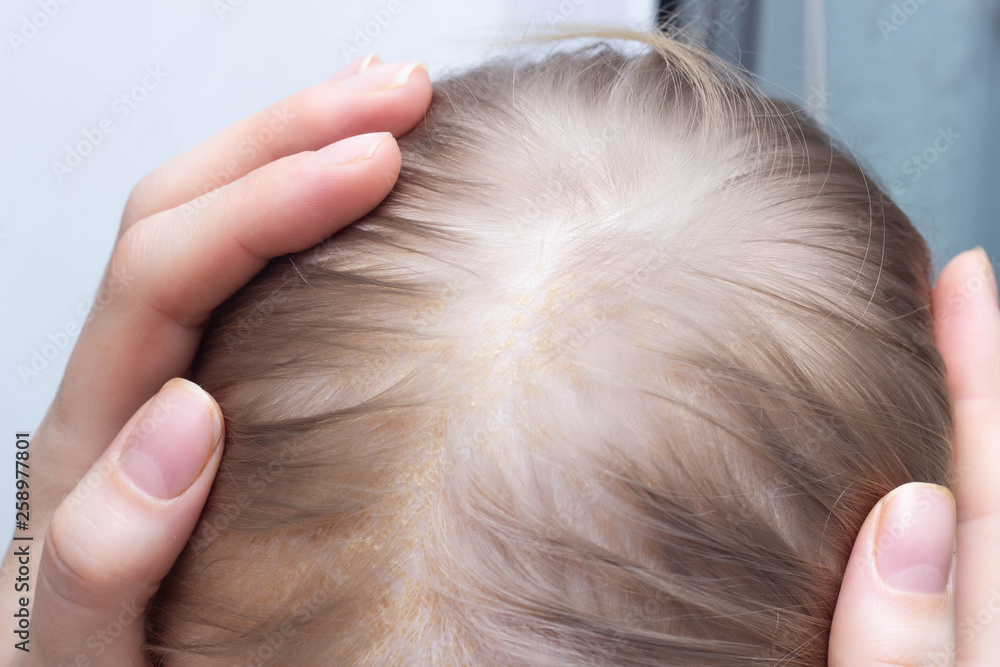 Fungal skin disease seborrheic dermatitis in a child's head, close-up, seborrhea crust, dermatology Fungal skin disease seborrheic dermatitis in a child's head, close-up, seborrhea crust, dermatology