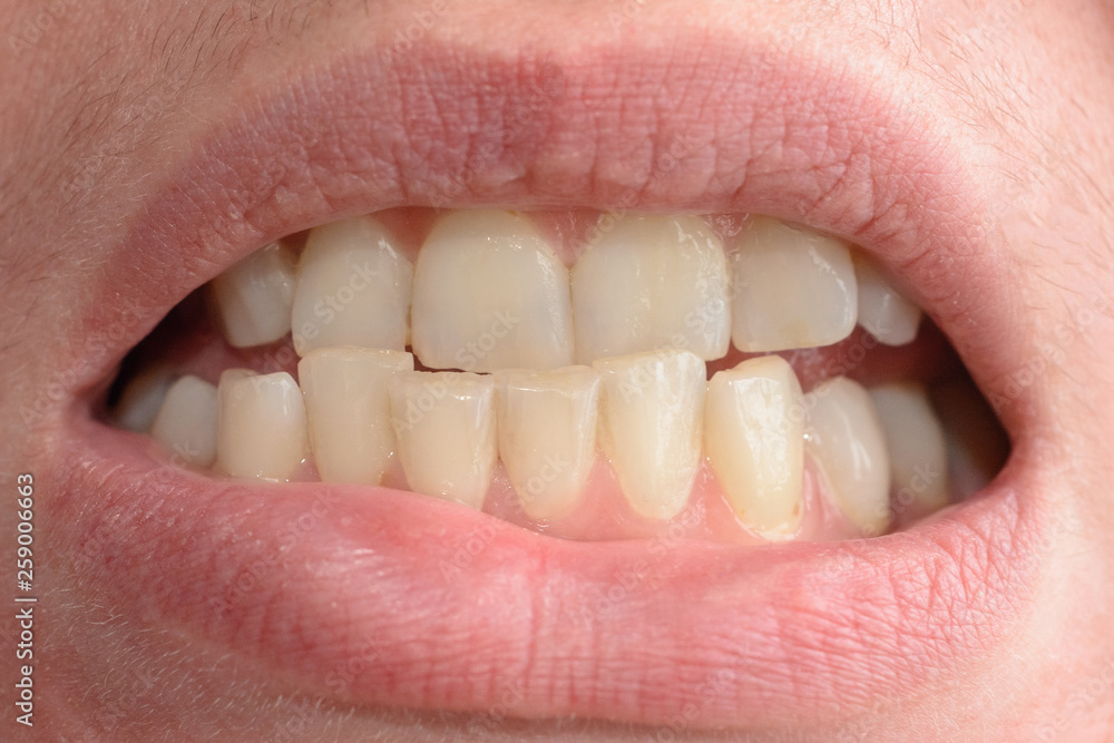 Fototapeta premium A young woman shows her crooked teeth that needs medical help in close-ups