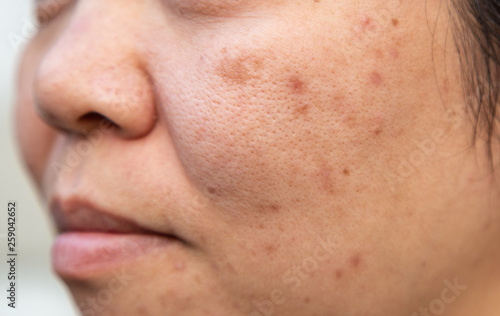 Papier peint Problems facial skin is acne and blemishes.
