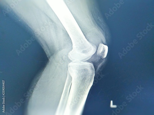 Knee joint x-ray lateral views Fracture tibial eminence is suspected. Left knee joint fluid is seen