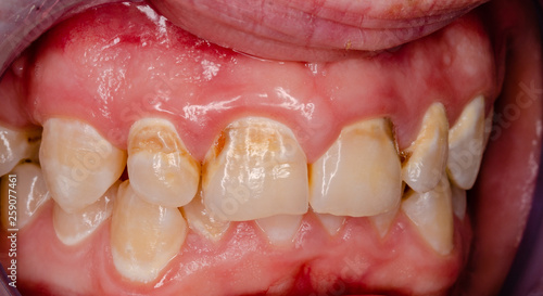 Fotografie frontal teeth with tooth decay