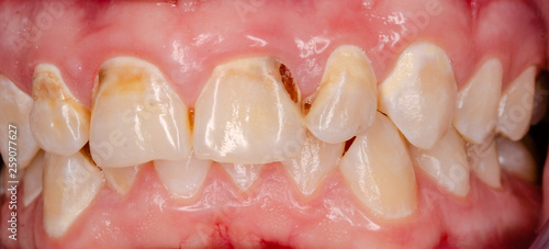 Fotografie frontal teeth with tooth decay