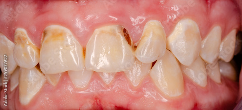 frontal teeth with tooth decay photo