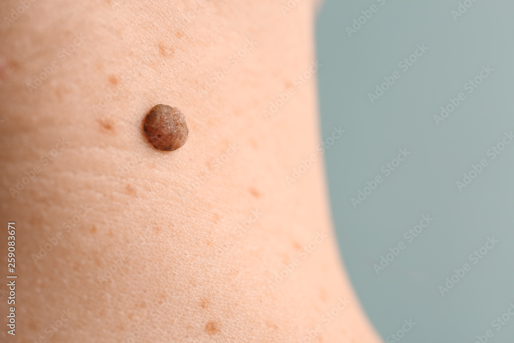 Fototapeta premium Young woman with moles, closeup