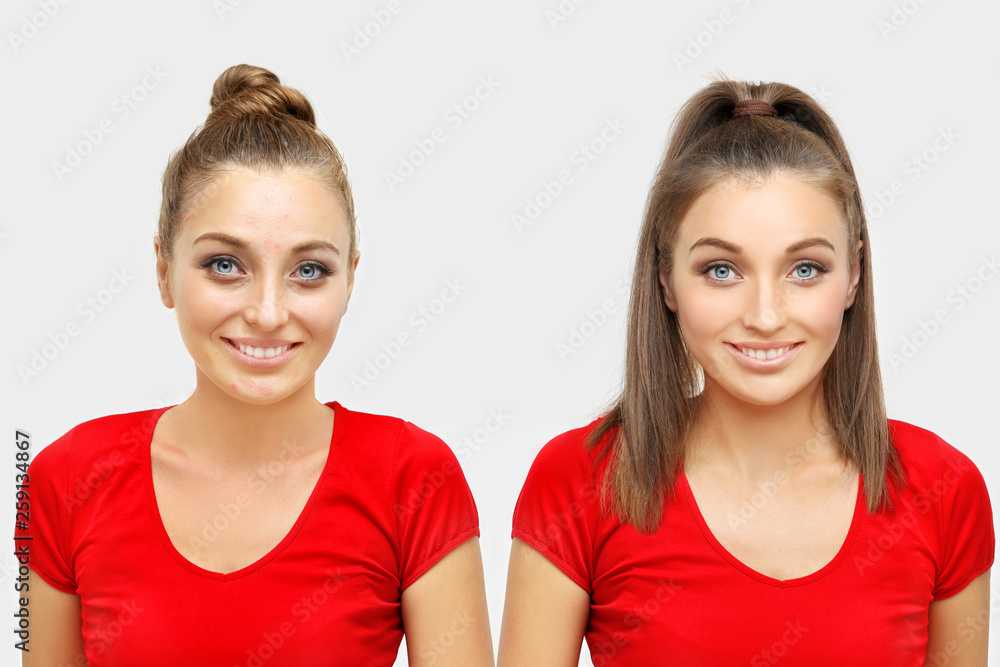 The Secret of Makeup. Before- After,Portrait of beautiful girl with problem and clear skin The Secret of Makeup. Before- After,Portrait of beautiful girl with problem and clear skin