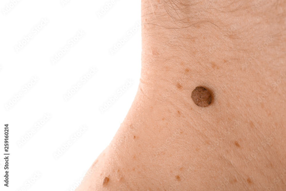 Fototapeta premium Young woman with moles on white background, closeup