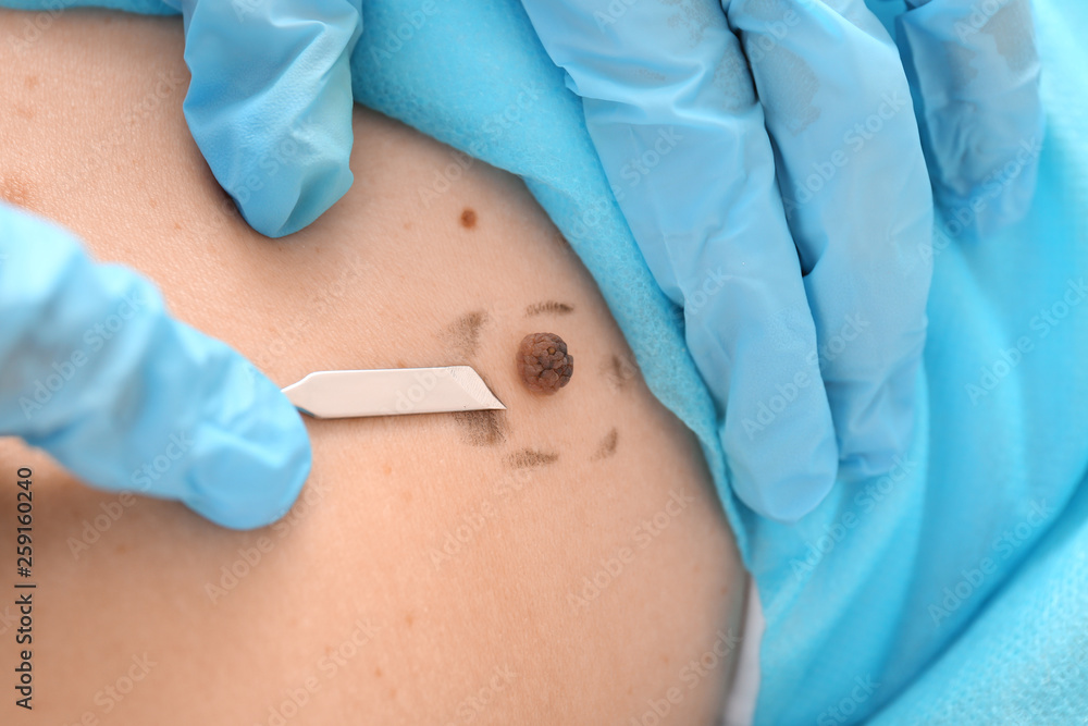 Doctor with lancet going to remove mole from patient's skin, closeup Doctor with lancet going to remove mole from patient's skin, closeup