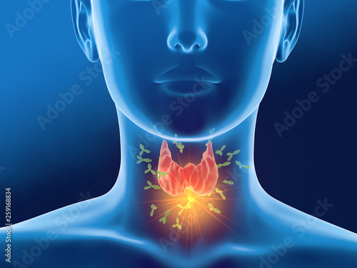 Antibodies attacking thyroid gland of a woman, Autoimmune thyroiditis, Hashimoto's disease ..