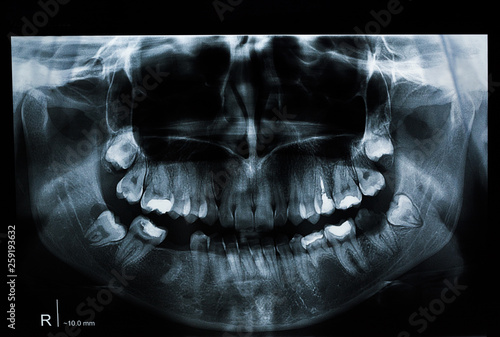Panoramic dental x-ray of a person with teeth problems. Young female radiography. Missing tooth. Fillings and root canal obturation.  photo
