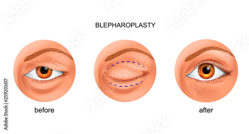 blepharoplasty of the overhanging eyelid photo