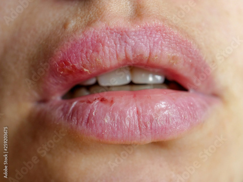 Beautiful female lips cracked from frost, wind, lack of vitamins. Sore from herpes virus. Lips need hygiene