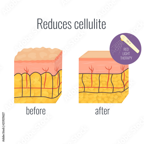 Cell illustration with cellullite and without.