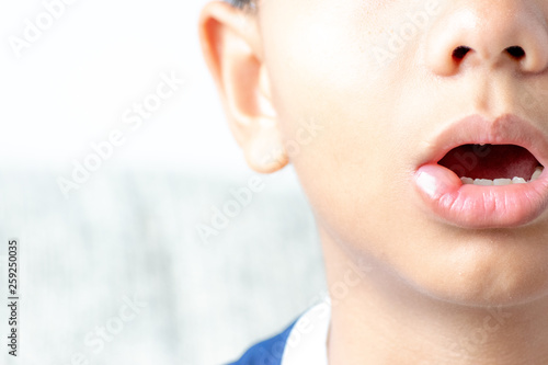 Allergic reaction on child mouth skin after bee stings. Health care  Medical concept.
