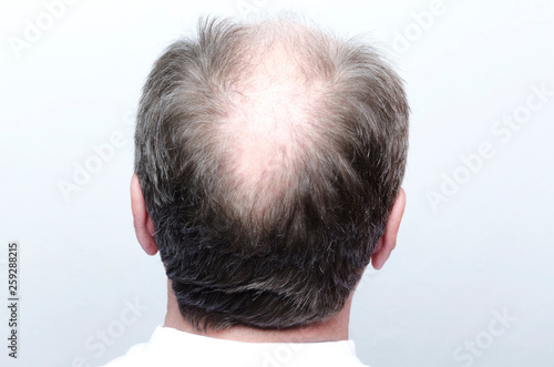 Back of male bald head.Concept of baldness